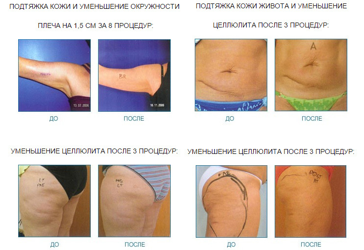 Лечение целлюлита кожи Лечение целлюлита кожи