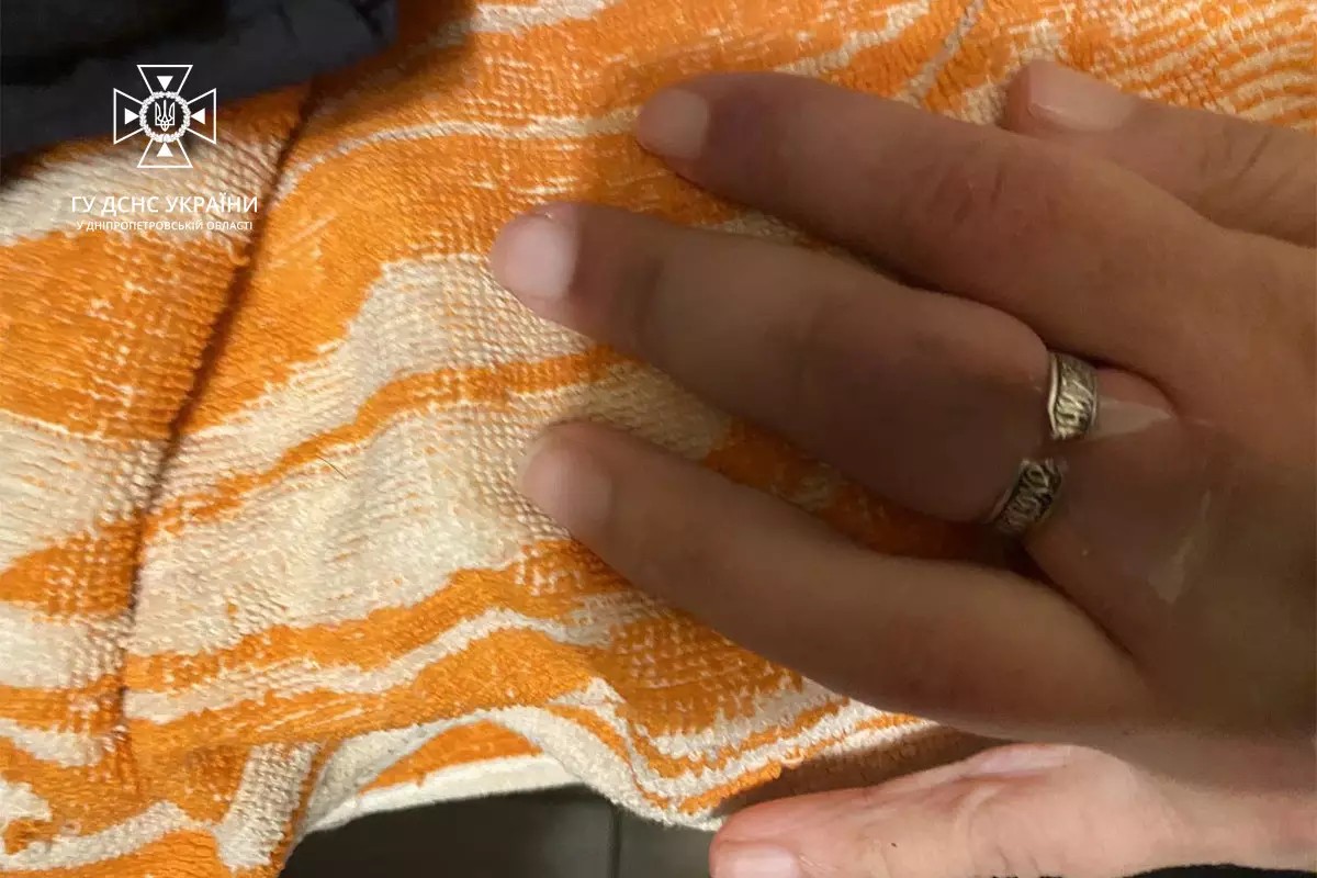 У Дніпрі рятувальники зняли обручку з пальця жінки